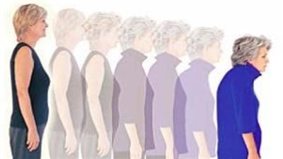 4 أطعمة تحميك من الإصابة بهشاشة العظام