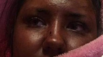 امرأة تتحول إلى «غول» بسبب كريم للبشرة (صور)