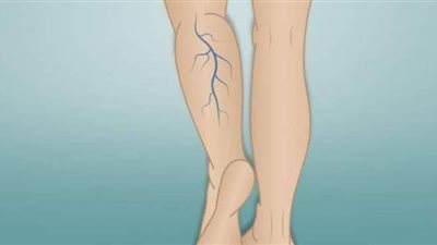 تعرف على أعراض الدوالي.. و6 عوامل تزيد من خطورة إصابتك بها