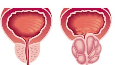 علاج تضخم البروستاتا وأهم أعراضها