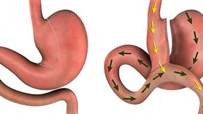 استشاري يوضح الفرق بين تحويل المسار وكشكشة المعدة الدقيق