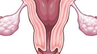 علاج تكيس المبايض للمتزوجة