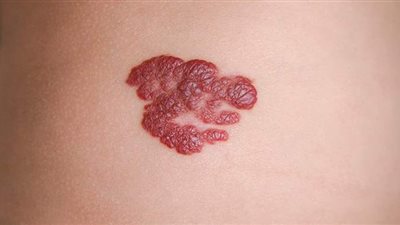 أعراض الوحمة الدموية وأهم أنواعها