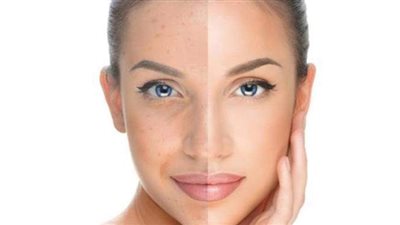 وصفات طبيعية تساعدك في التخلص من البقع الداكنة وتبيض بشرتك