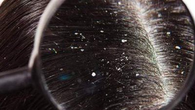 ما هي أسباب القشرة وطرق الوقاية والعلاج؟ استشاري يُجيب