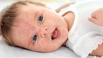 أعراض وأسباب حساسية الألبان