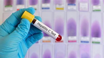 أعراض فيروس سي وأسبابه وطرق الوقاية