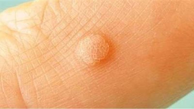 مرض عين السمكة وأنواعه وأعراضه.. وطرق الوقاية