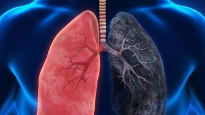 طبيب أورام: ٩٠% من حالات سرطان الرئة بسبب التدخين