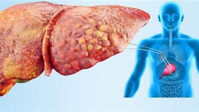 أعراض الكبد الدهني .. وبحث أمريكي جديد يكتشف علاجا للمرض