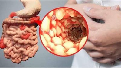 بعد إصابة حمو بيكا به.. تعرف على أعراض مرض كرون وطرق العلاج الطبيعية