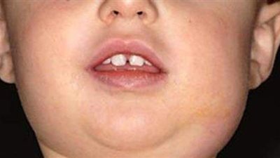 أعراض الغدة النكافية