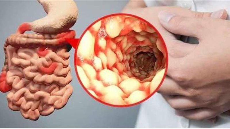 أعراض مرض كرون