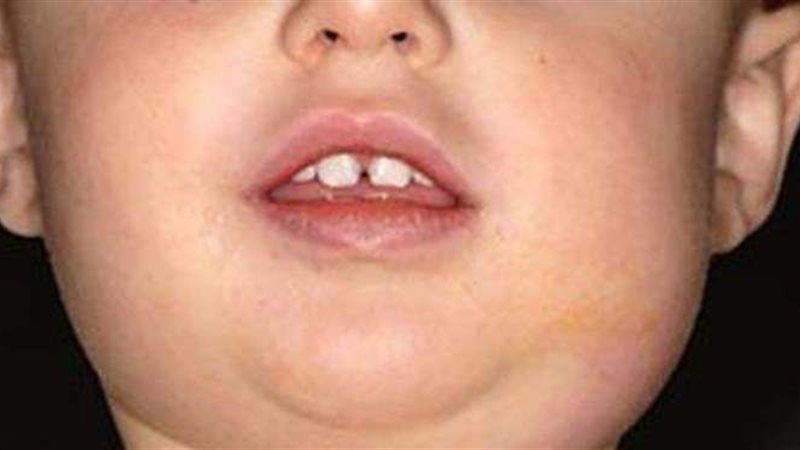 أعراض الغدة النكافية