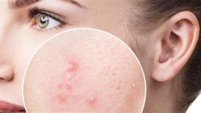 طرق إزالة حفر الوجه بطريقة سريعة