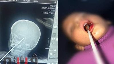 إنقاذ طفل اخترق سيخ حديد جمجمته ببني سويف