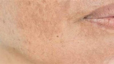 اعرفي طرق التخلص من تصبغات الجلد والبشرة