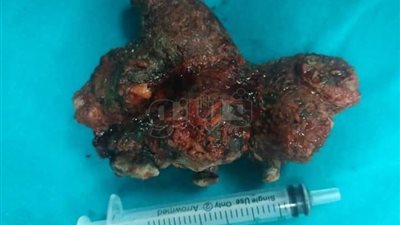 إزالة حصوة وزنها 250 جراما لمريض في مستشفى التأمين بقنا (صور)