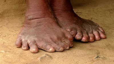 امرأة هندية بـ 31 إصبع تثير رعب جيرانها (صور)