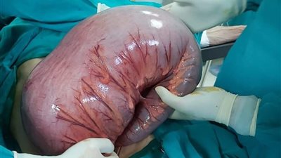 استئصال ورم يزن 15 كيلو من جسد مريض بالمنيا (صور)