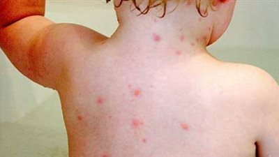 أعراض الجديري عند الأطفال (فيديو)