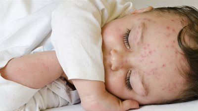 طرق استحمام الطفل مريض الجديري (فيديو)