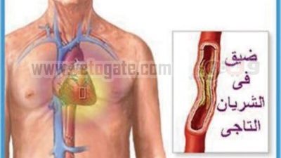 أمراض القلب تقتل 71 مليون شخص سنوياً