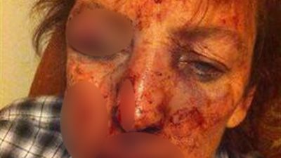 بالصور.. امرأة تنشر صورا مروعة لمساعدة ضحايا العنف المنزلي