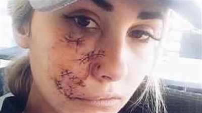 كلب يشوه وجه عارضة أزياء بأستراليا (صور)