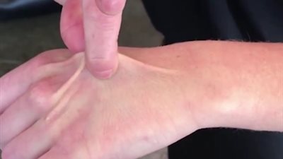 اختبار اليد يكشف حاجة الجسد للمياه في ثوانٍ (فيديو)