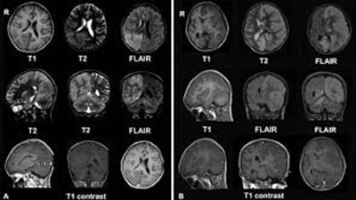 دراسة تكشف العلاقة بين الوسواس القهري والتهاب المخ