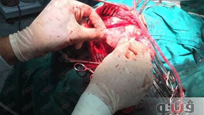 فريق من طب الأزهر بدمياط ينجح في إجراء عملية كسر عظام بالجمجمة