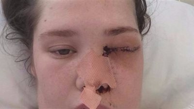 فتاة تخسر عينها بسبب خراج في ضرسها