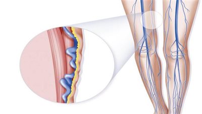 اعراض جلطة القدم