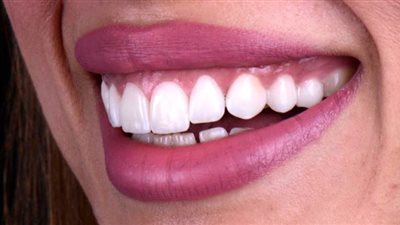 تجميل الأسنان.. ماذا يجب عليك فعله قبل تركيب لومينير الأسنان