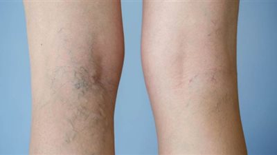 تقنية فعالة وسريعة لعلاج دوالي الساقين