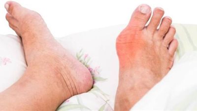 5 وصفات طبيعية تساعد فى علاج النقرس