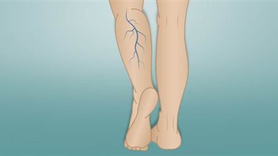 أعراض الإصابة بمرض الدوالي وطرق العلاج