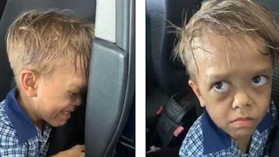 أعظم طفل فى العالم.. حكاية قزم تمنى الموت وانتفض أصحاب القلوب الرحيمة لإسعاده