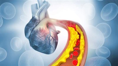 أعراض زيادة الكوليسترول في الدم.. وأهم النصائح لعلاجه
