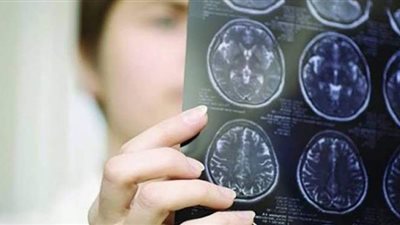 كل ما تريد معرفته عن مرض التصلب اللويحي المتعدد