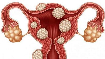 علاج تكيس المبايض لدى السيدات