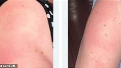 بعد تلقيهم لقاح موديرنا.. إصابة أشخاص ببقع حمراء وطفح جلدي