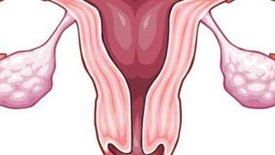 آلام شديدة أثناء الدورة.. بطانة الرحم المهاجرة وأهم أعراضها