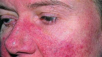 ما هو مرض الذئبة الحمراء.. تعرف على أعراضه وعلاجه