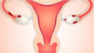 كيف يحدث الحمل خارج الرحم وهل يستمر؟