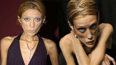 مرض بوليميا.. الأسباب والأعراض والعلاج