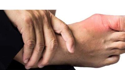 كل ما تود معرفته عن علاج مرض النقرس نهائيا