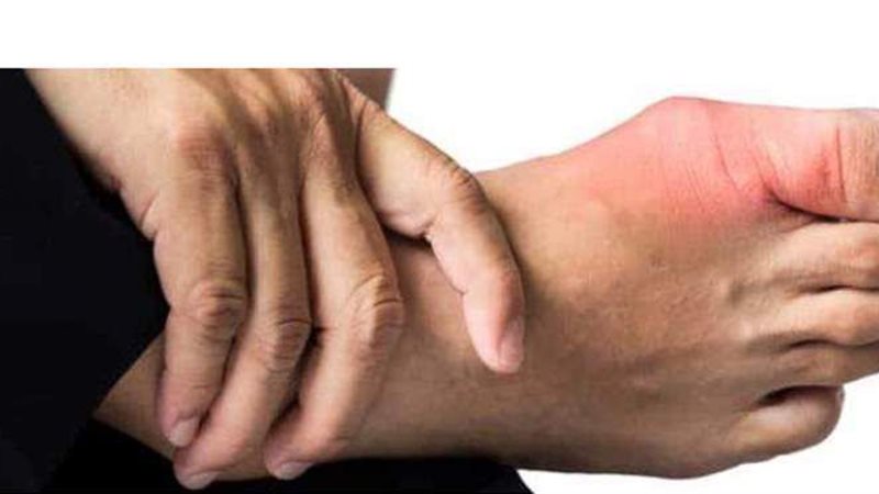 علاج مرض النقرس