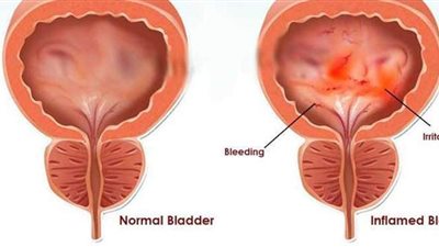 أعراض التهاب المثانة.. وطرق العلاج الطبيعية بالأعشاب